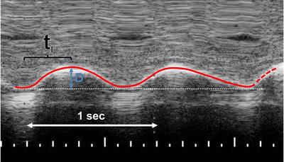 Diaphragmatic ultrasound and patent ductus arteriosus in the newborn: A retrospective case series